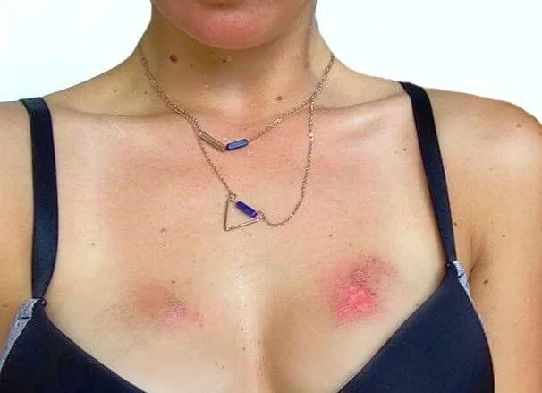 Anne mit Surf Rashes durch zu viel Bikini Surf Anne mit Surf Rashes durch zu viel Bikini Surf